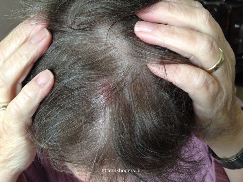 rode vlekken op hoofdhuid