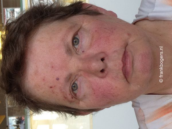 hoelang duurt gordelroos