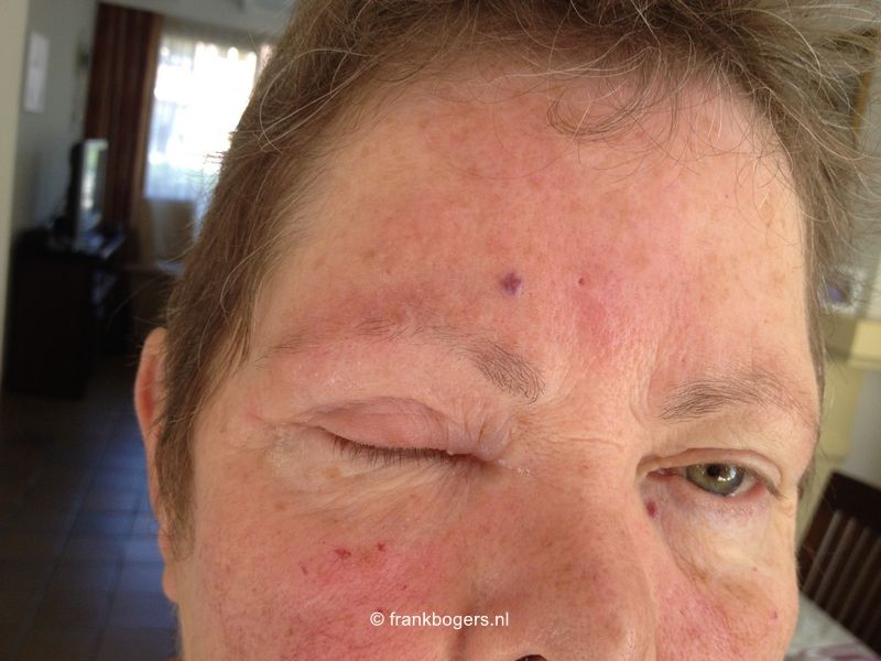 gordelroos jeuk rode vlekken blaasjes korstjes blaar ogen