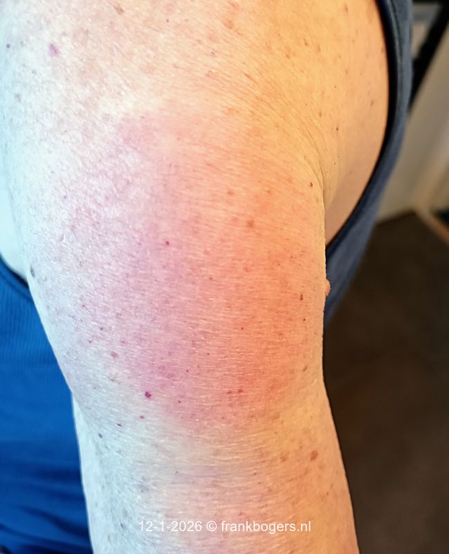 rode plek arm gevoelig na gordelroos injectie